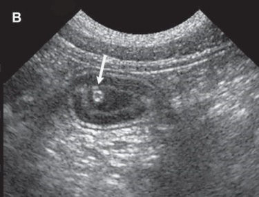 [최민철의 초음파 이야기] 초음파영상으로 이물찾기① 소화기 이물