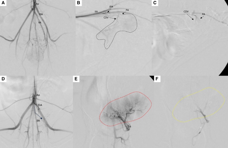 전성훈 해마루 인터벤션센터장, 혈관 인터벤션시술 성과 SCIE 국제학술지에 연이어 발표